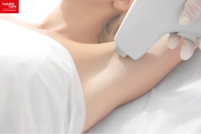 femme épilation laser aisselle